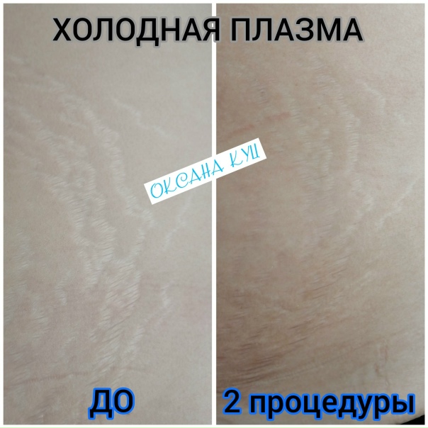 Холодная плазма: метод омоложения без иголок и долгого восстановления! NataBeaut