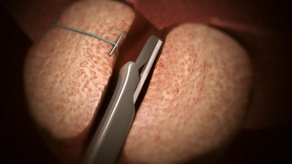UroLift System for BPH Procedure Animation